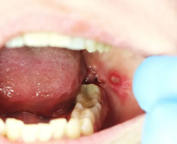 Dlaczego afty często nawracają i jak ograniczyć ich częstotliwość?