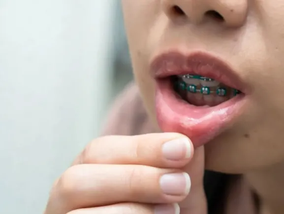 Jakie środki ostrożności stosować po wyleczeniu aft, aby nie wracały?