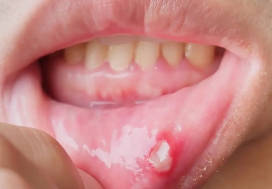 Jak prowadzić dziennik nawrotów aft i co można z niego wyczytać?